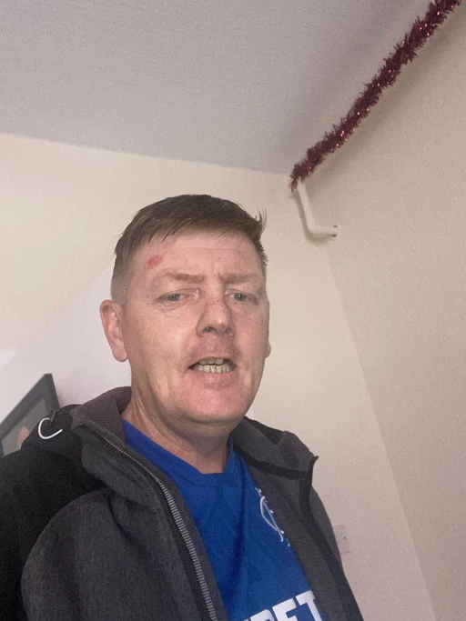 Fell and had a bump on my head